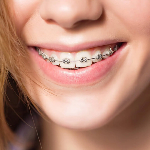 Braces in Port St. Lucie West