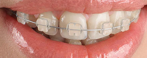 Clear Braces in Port St. Lucie West