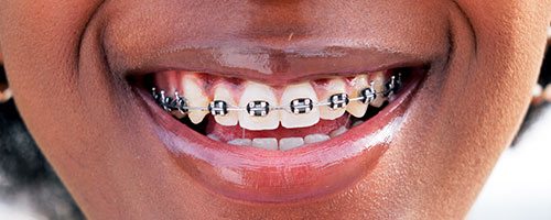 Traditional Metal Braces in Port St. Lucie West